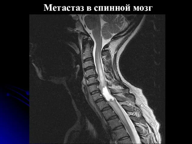 Метастаз в спинной мозг