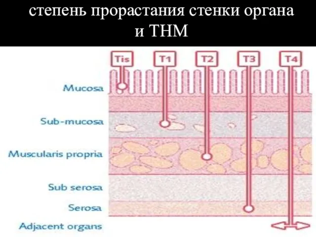 степень прорастания стенки органа и ТНМ