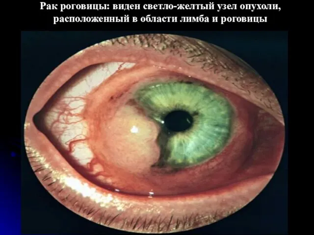 Рак роговицы: виден светло-желтый узел опухоли, расположенный в области лимба и роговицы