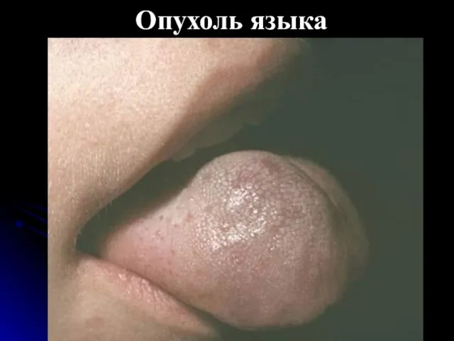 Опухоль языка