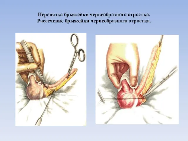 Перевязка брыжейки червеобразного отростка. Рассечение брыжейки червеобразного отростка.