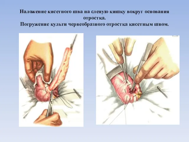 Наложение кисетного шва на слепую кишку вокруг основания отростка. Погружение культи червеобразного отростка кисетным швом.