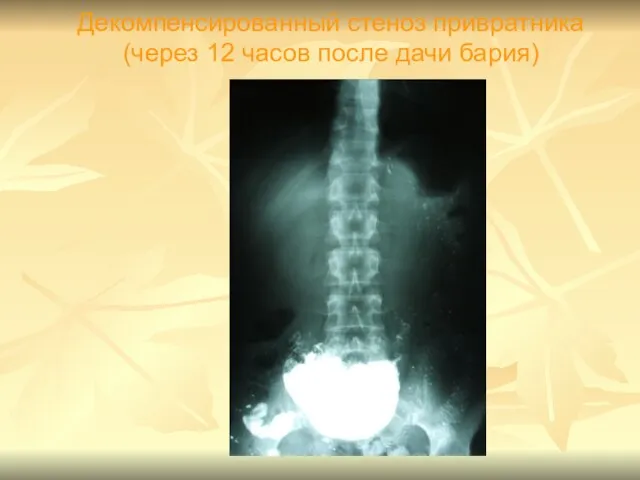 Декомпенсированный стеноз привратника (через 12 часов после дачи бария)