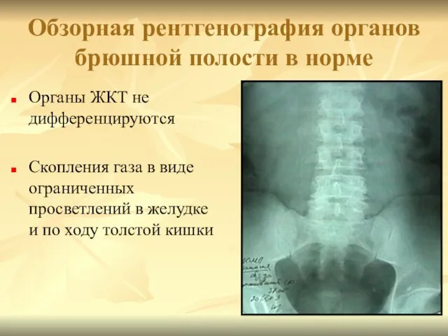 Обзорная рентгенография органов брюшной полости в норме Органы ЖКТ не дифференцируются