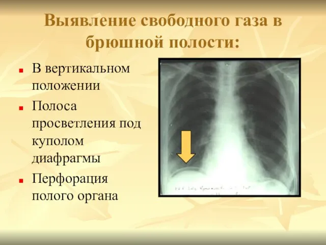 Выявление свободного газа в брюшной полости: В вертикальном положении Полоса просветления