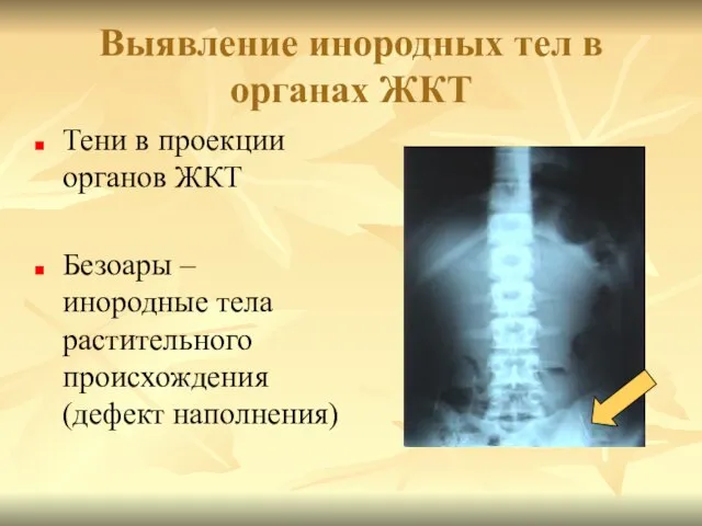 Выявление инородных тел в органах ЖКТ Тени в проекции органов ЖКТ