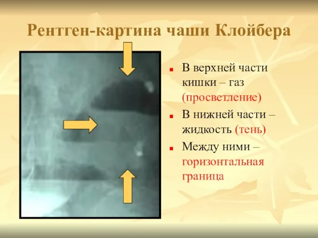 Рентген-картина чаши Клойбера В верхней части кишки – газ (просветление) В