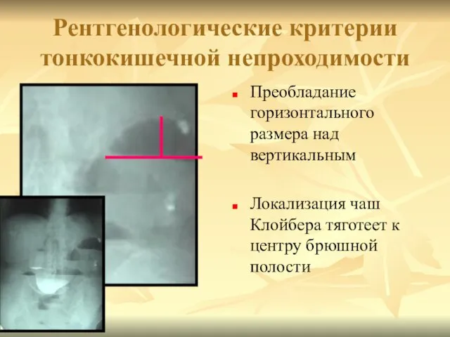 Рентгенологические критерии тонкокишечной непроходимости Преобладание горизонтального размера над вертикальным Локализация чаш