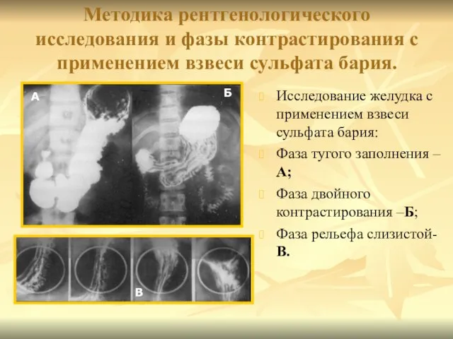 Методика рентгенологического исследования и фазы контрастирования с применением взвеси сульфата бария.