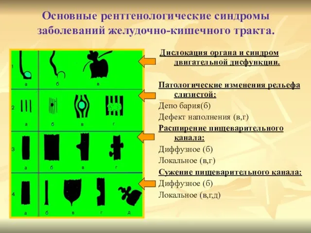 Основные рентгенологические синдромы заболеваний желудочно-кишечного тракта. Дислокация органа и синдром двигательной