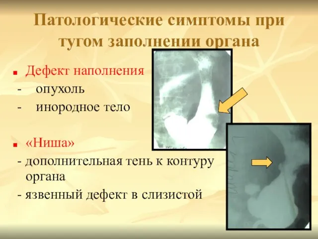 Патологические симптомы при тугом заполнении органа Дефект наполнения - опухоль -