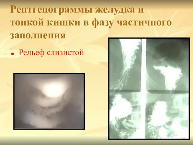 Рентгенограммы желудка и тонкой кишки в фазу частичного заполнения Рельеф слизистой