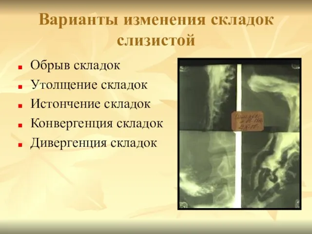 Варианты изменения складок слизистой Обрыв складок Утолщение складок Истончение складок Конвергенция складок Дивергенция складок