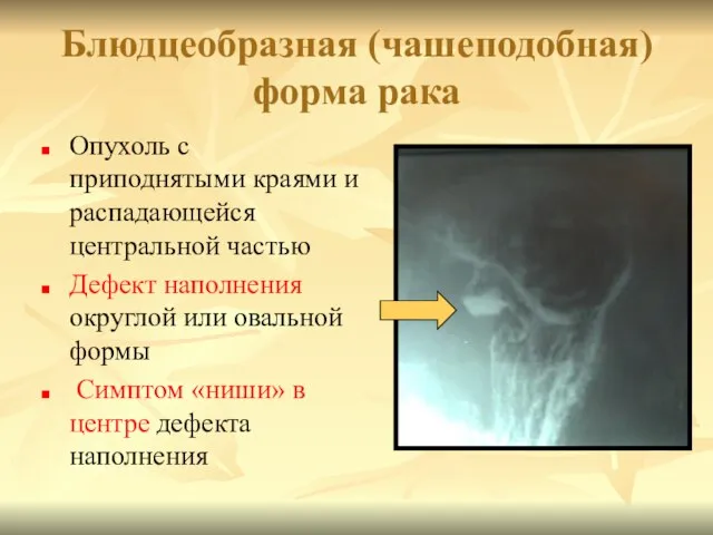 Блюдцеобразная (чашеподобная) форма рака Опухоль с приподнятыми краями и распадающейся центральной