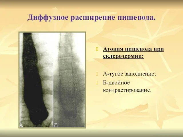 Диффузное расширение пищевода. Атония пищевода при склеродермии: А-тугое заполнение; Б-двойное контрастирование.