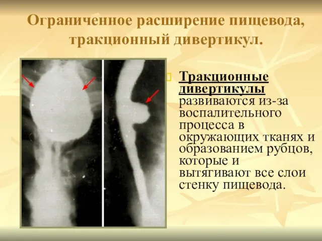 Ограниченное расширение пищевода, тракционный дивертикул. Тракционные дивертикулы развиваются из-за воспалительного процесса