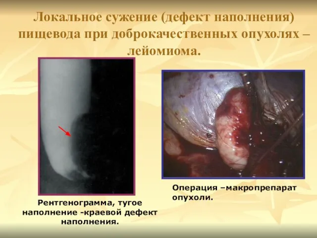 Локальное сужение (дефект наполнения) пищевода при доброкачественных опухолях – лейомиома. Рентгенограмма,