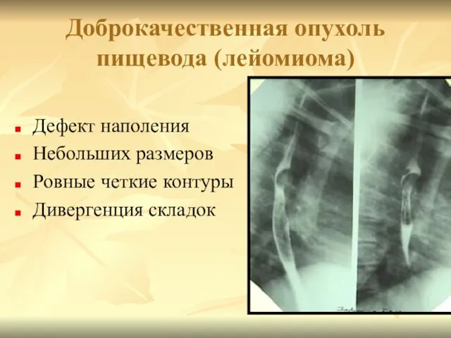 Доброкачественная опухоль пищевода (лейомиома) Дефект наполения Небольших размеров Ровные четкие контуры Дивергенция складок