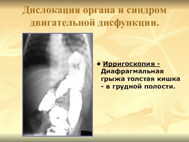 Дислокация органа и синдром двигательной дисфункции. Ирригоскопия -Диафрагмальная грыжа толстая кишка - в грудной полости.