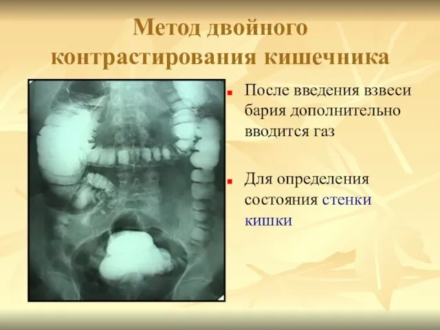 Метод двойного контрастирования кишечника После введения взвеси бария дополнительно вводится газ Для определения состояния стенки кишки