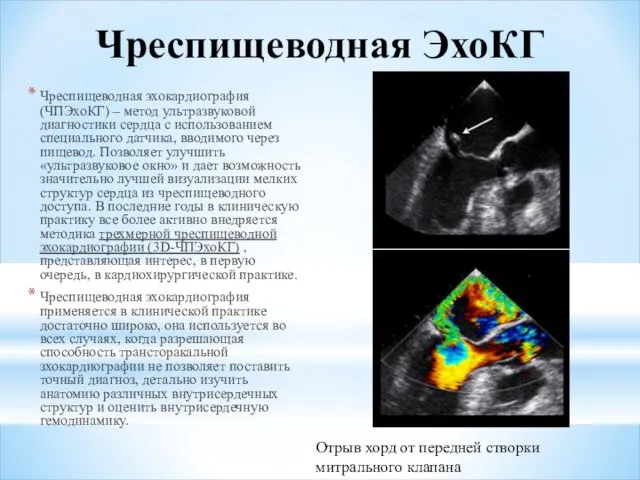 Чреспищеводная ЭхоКГ Чреспищеводная эхокардиография (ЧПЭхоКГ) – метод ультразвуковой диагностики сердца с