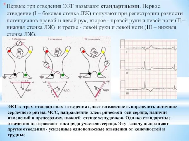 Первые три отведения ЭКГ называют стандартными. Первое отведение (I – боковая