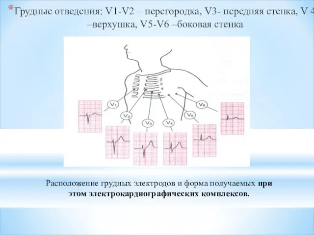 Грудные отведения: V1-V2 – перегородка, V3- передняя стенка, V 4 –верхушка,