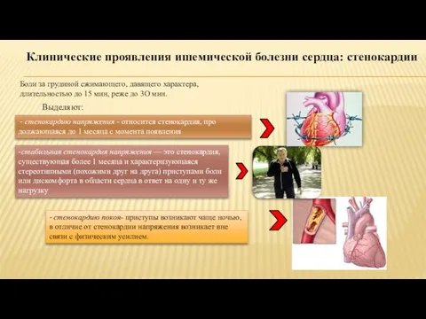 Клинические проявления ишемической болезни сердца: стенокардии Боли за грудиной сжимающего, давящего