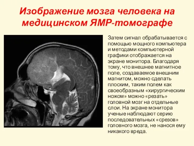 Изображение мозга человека на медицинском ЯМР-томографе Затем сигнал обрабатывается с помощью