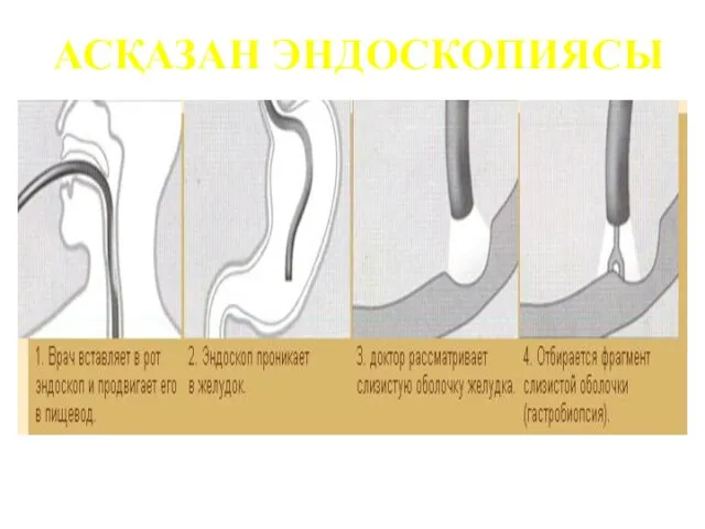 АСҚАЗАН ЭНДОСКОПИЯСЫ