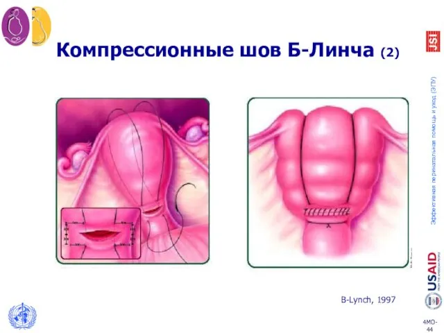 Компрессионные шов Б-Линча (2) B-Lynch, 1997