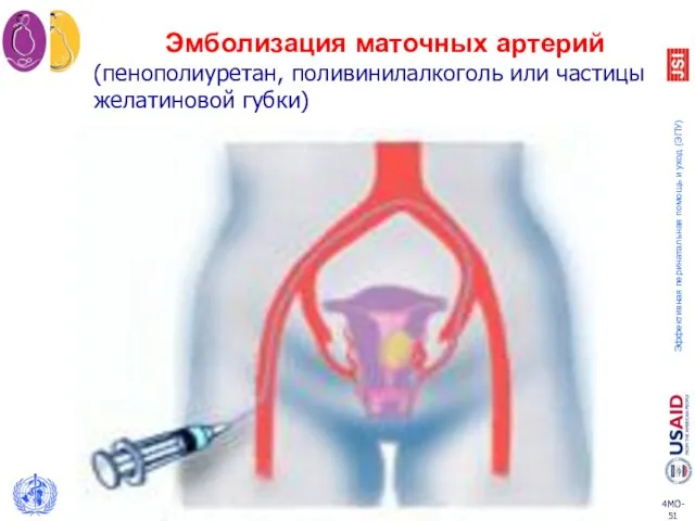 Эмболизация маточных артерий (пенополиуретан, поливинилалкоголь или частицы желатиновой губки)