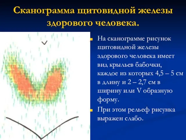 Сканограмма щитовидной железы здорового человека. На сканограмме рисунок щитовидной железы здорового