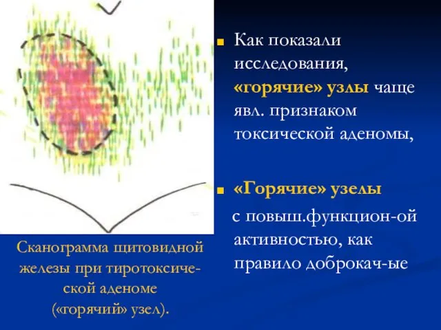 Как показали исследования, «горячие» узлы чаще явл. признаком токсической аденомы, «Горячие»