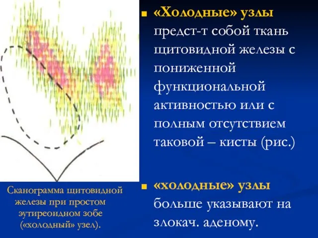 «Холодные» узлы предст-т собой ткань щитовидной железы с пониженной функциональной активностью