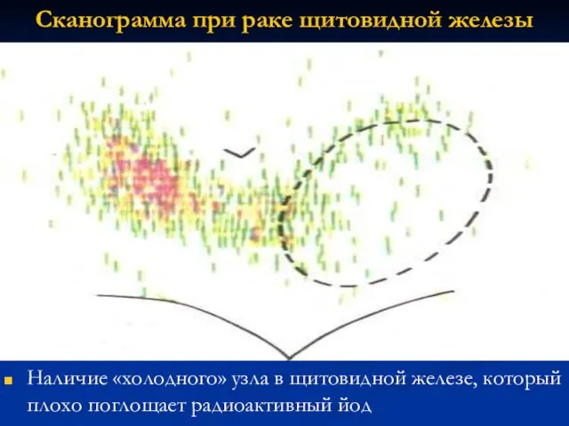 Наличие «холодного» узла в щитовидной железе, который плохо поглощает радиоактивный йод Сканограмма при раке щитовидной железы