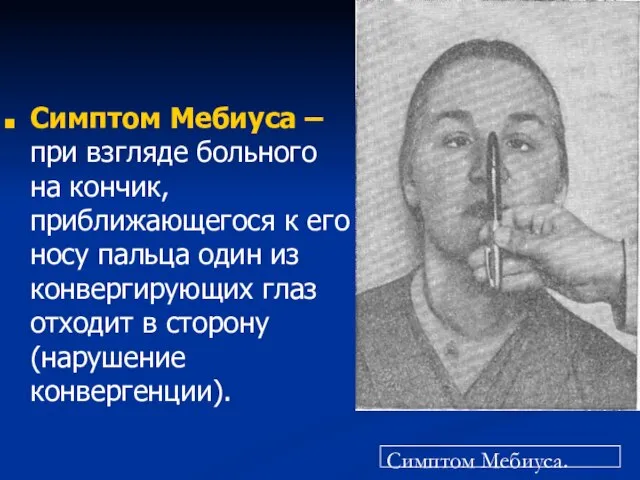 Симптом Мебиуса – при взгляде больного на кончик, приближающегося к его