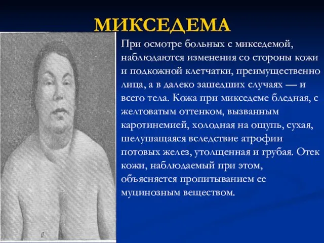 МИКСЕДЕМА При осмотре больных с микседемой, наблюдаются изменения со стороны кожи