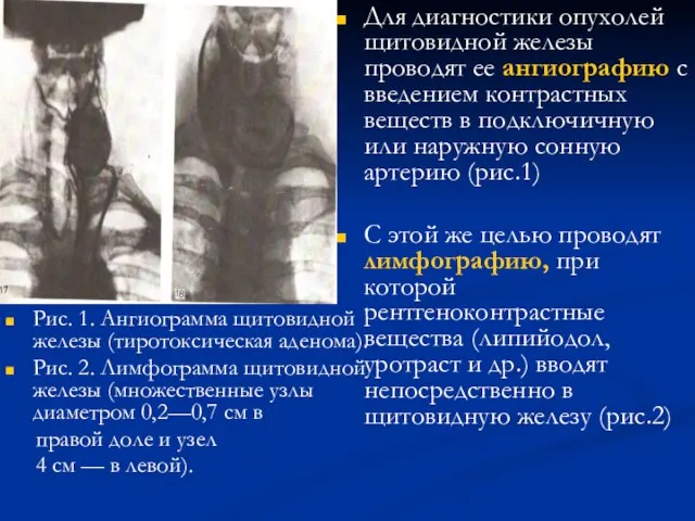 Рис. 1. Ангиограмма щитовидной железы (тиротоксическая аденома). Рис. 2. Лимфограмма щитовидной