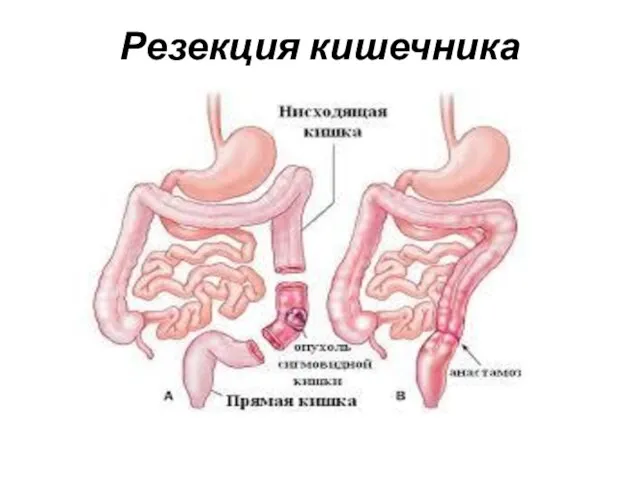 Резекция кишечника