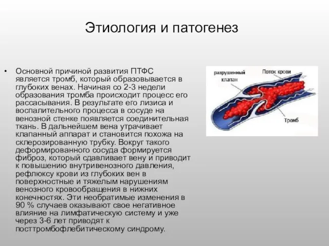 Этиология и патогенез Основной причиной развития ПТФС является тромб, который образовывается