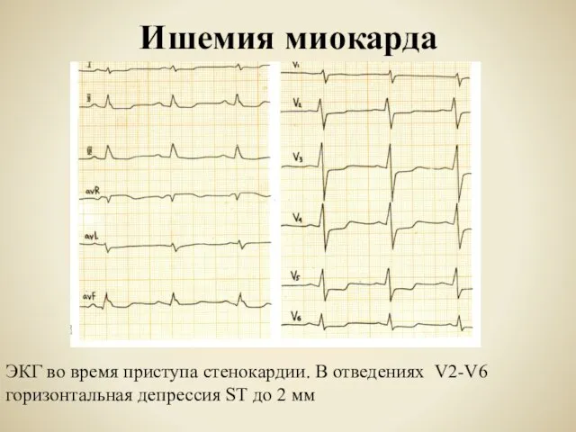 Ишемия миокарда ЭКГ во время приступа стенокардии. В отведениях V2-V6 горизонтальная депрессия ST до 2 мм