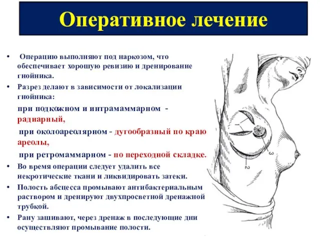 Оперативное лечение Операцию выполняют под наркозом, что обеспечивает хорошую ревизию и