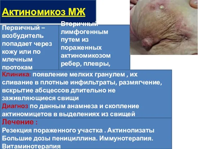 Актиномикоз МЖ Первичный – возбудитель попадает через кожу или по млечным