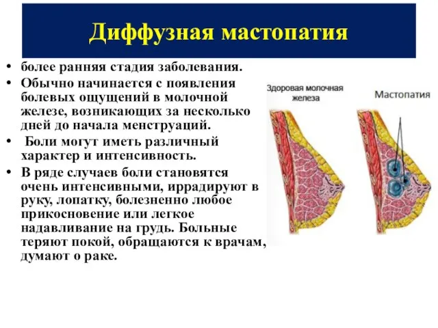 Диффузная мастопатия более ранняя стадия заболевания. Обычно начинается с появления болевых