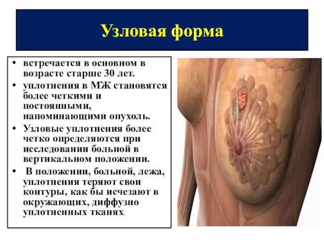 Узловая форма встречается в основном в возрасте старше 30 лет. уплотнения