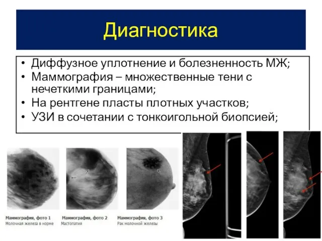 Диагностика Диффузное уплотнение и болезненность МЖ; Маммография – множественные тени с