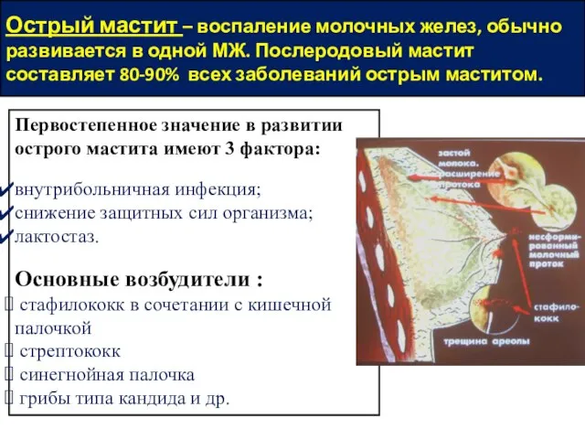 Острый мастит – воспаление молочных желез, обычно развивается в одной МЖ.