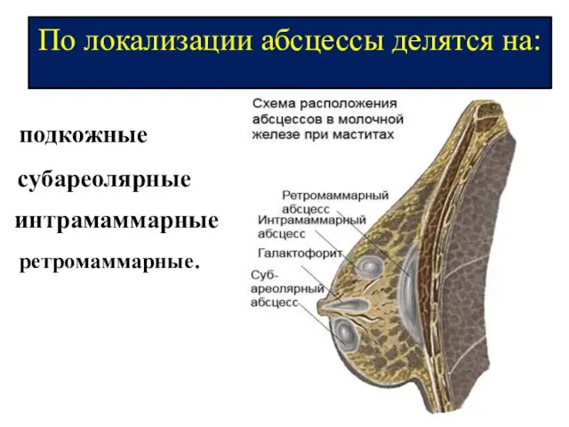 По локализации абсцессы делятся на: подкожные субареолярные интрамаммарные ретромаммарные.