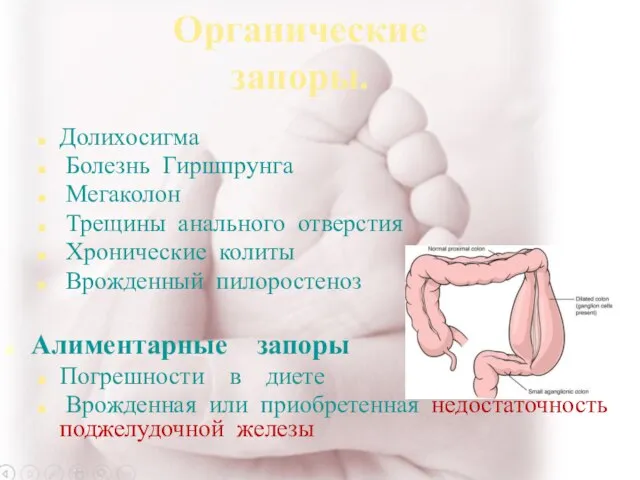 Органические запоры. Долихосигма Болезнь Гиршпрунга Мегаколон Трещины анального отверстия Хронические колиты